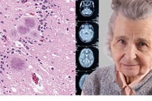 EL ALZHEIMER SE TRANSMITE COMO LAS ENFERMEDADES INFECCIOSAS