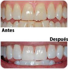 �ES SEGURO EL BLANQUEAMIENTO DENTAL?