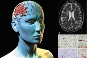 IDENTIFICAN GEN QUE MATA A LOS 40 A�OS