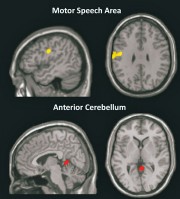 EL COEFICIENTE INTELECTUAL VAR�A DURANTE LA ADOLESCENCIA