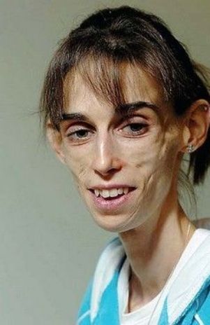FALLECE LA MUJER CON EL PEOR CASO DE ANOREXIA