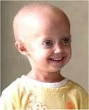 PROGERIA: CAUSAS, S�NTOMAS Y TRATAMIENTO