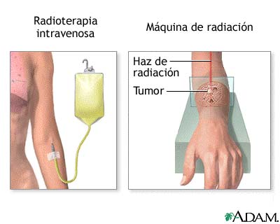 INTOXICACI�N POR RADIACI�N. S�NTOMAS Y TRATAMIENTOS