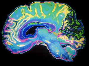 C�MO ACT�A EL ALZHEIMER