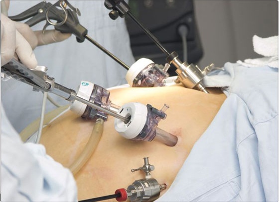 �EL BYPASS G�STRICO PROVOCA ALCOHOLISMO?