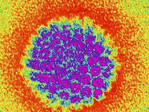 C�MO EST�N RELACIONADOS EL ALZHEIMER Y EL HERPES