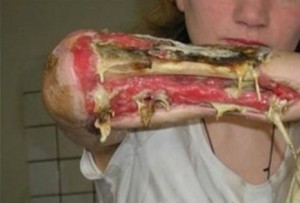 C�MO ACT�A 'KROKODIL' LA DROGA BARATA QUE SUSTITUYE A LA HERO�NA - FOTOS