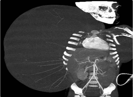 EXTIRPAN TUMOR DE 15 KILOS A NI�O DE DOS A�OS